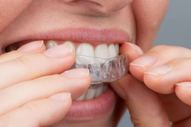 Step-by-Step Guide to Getting Invisible Aligners in San Francisco